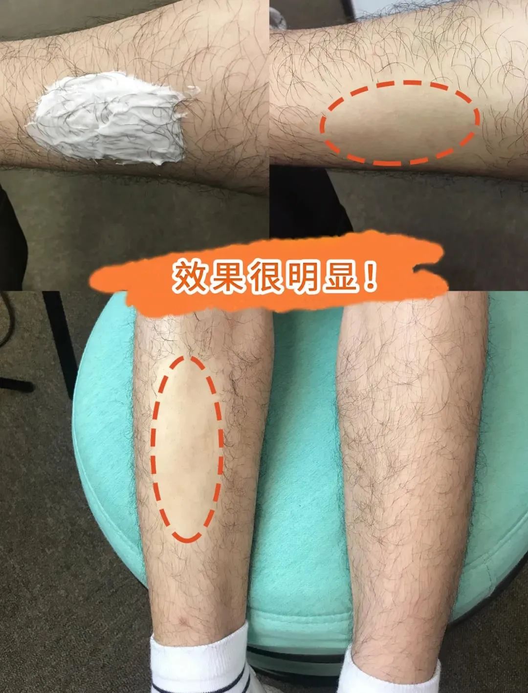 【全国到家】【屈臣氏断货王丨水之蔻脱毛膏丨全网爆卖400W+支】5分钟告别“毛手毛脚”! 29.9元=2支抢门市价179元【水之蔻脱毛膏】!小红书、微博真实用户口碑推荐!安全温和、一抹即净、气温清香~敏感肌、体毛星人必入!(买一发二,脱毛膏80g,赠抑毛舒缓液)!